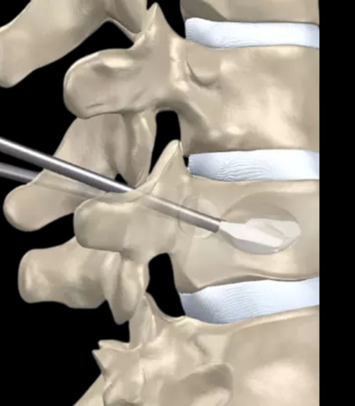 Myofascial trigger release