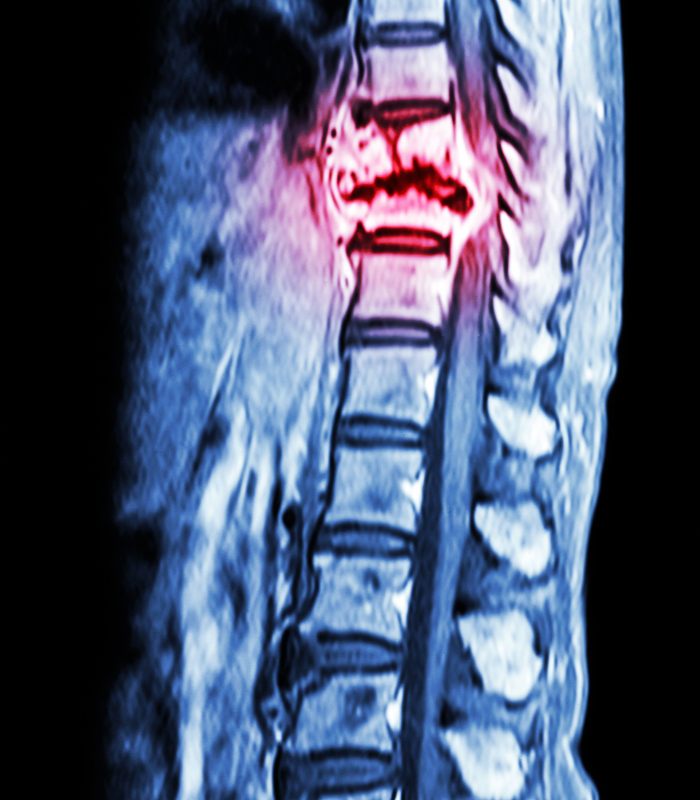 Myofascial trigger release